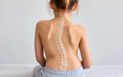Escoliosis en niños: causas y cuándo consultar